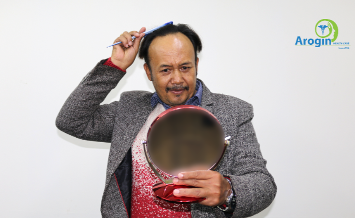 Hair Transplant Failure: Causes, Prevention, and How to Ensure Success